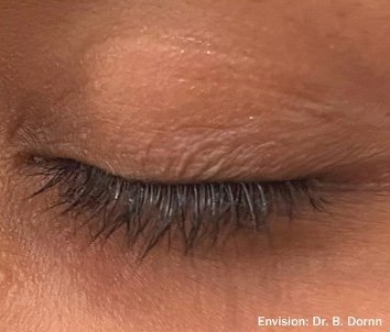 After: Envision Dry Eye Forma I (RF)