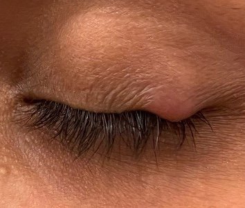 Before: Envision Dry Eye Forma I (RF)