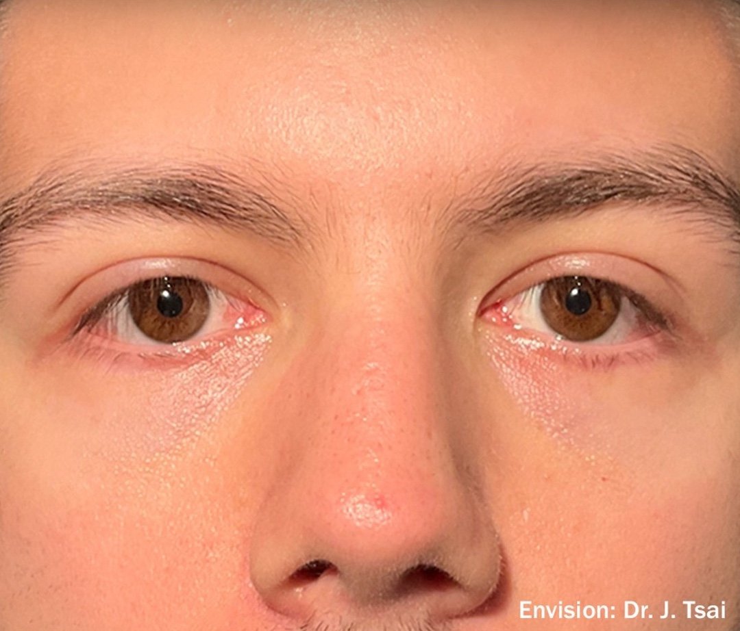 After: Envision Dry Eye Lumecca I (IPL)