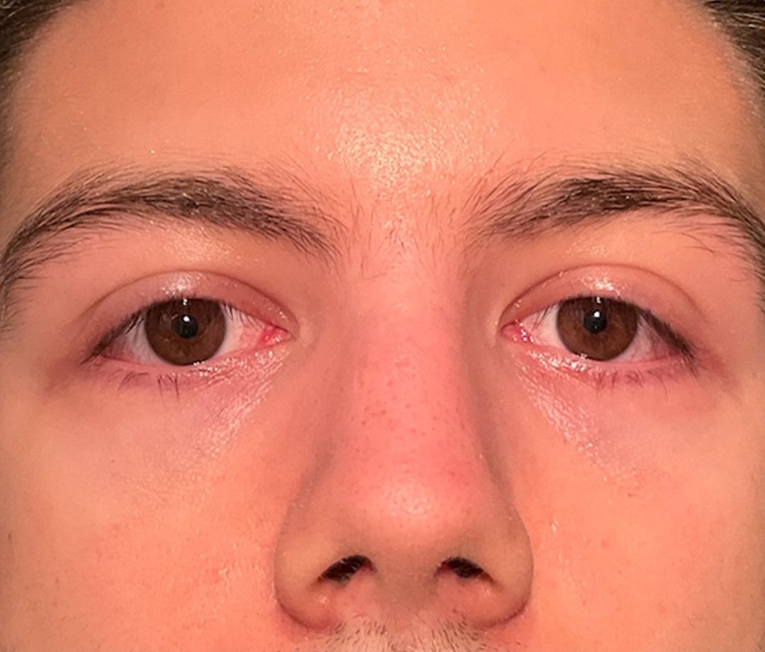 Before: Envision Dry Eye Lumecca I (IPL)