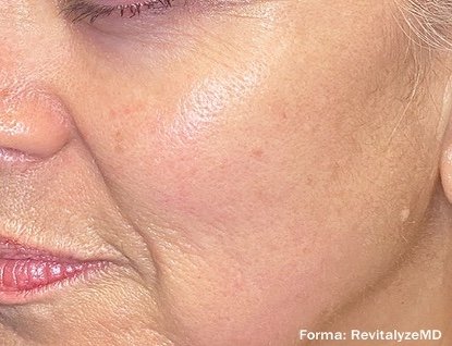 After: Forma Facial