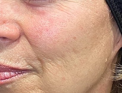 Before: Forma Facial