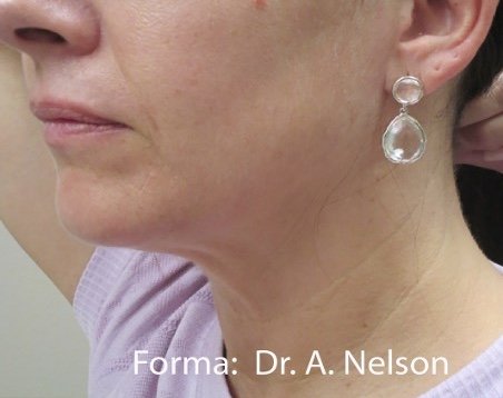 After: Forma Jawline Sculpting