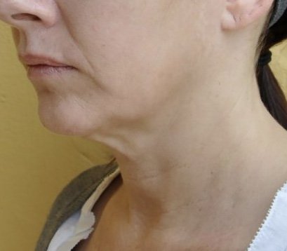 Before: Forma Jawline Sculpting