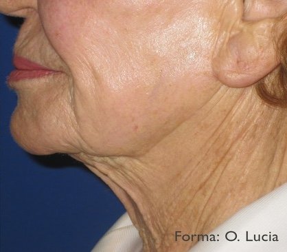 After: Forma Neck
