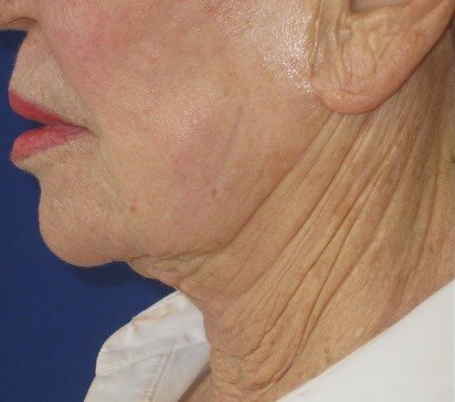 Before: Forma Neck