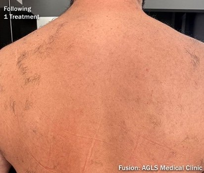 After: Laser Hair Removal (Fusion Light & Dark) Back