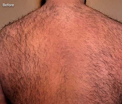 Before: Laser Hair Removal (Fusion Light & Dark) Back