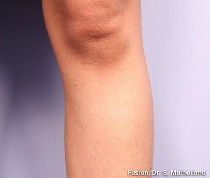 After: Laser Hair Removal (Fusion Light & Dark) Legs