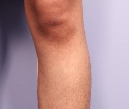 Before: Laser Hair Removal (Fusion Light & Dark) Legs