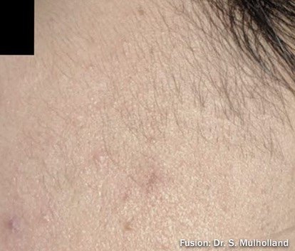 After: Laser Hair Removal (Fusion Light & Dark) Sideburns