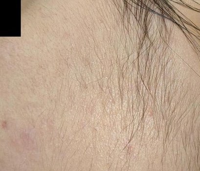 Before: Laser Hair Removal (Fusion Light & Dark) Sideburns
