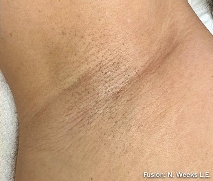 After: Laser Hair Removal (Fusion Light & Dark) Underarms