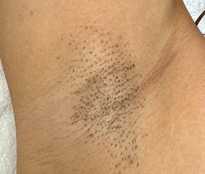 Before: Laser Hair Removal (Fusion Light & Dark) Underarms