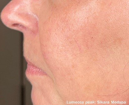After: Lumecca Peak (Face)