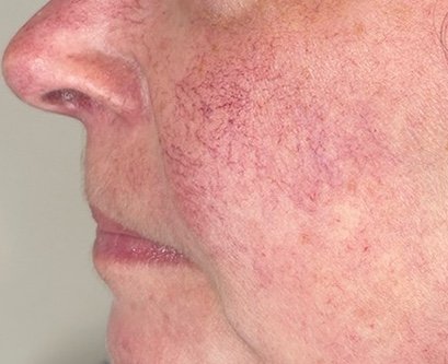 Before: Lumecca Peak (Face)