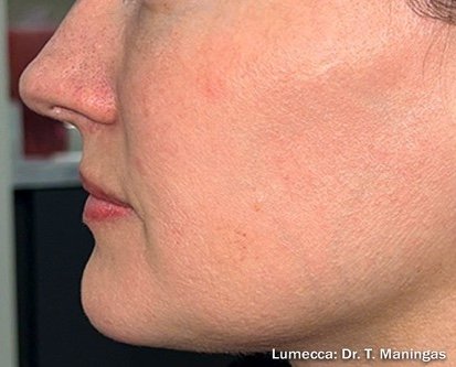 After: Lumecca Peak (Face & Neck)