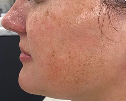 Before: Lumecca Peak (Face & Neck)