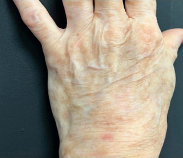 After: Lumecca Peak (Hands)