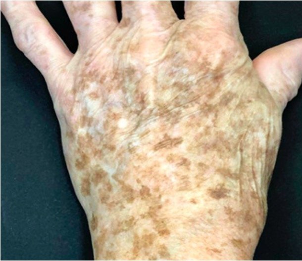 Before: Lumecca Peak (Hands)