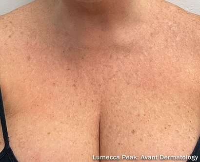 After: Lumecca Peak (Large Area)