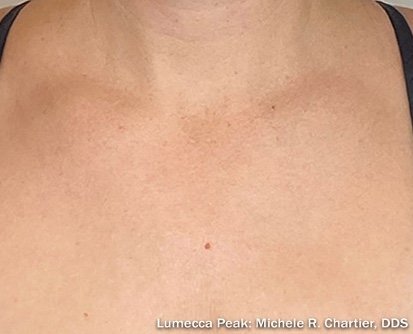 After: Lumecca Peak (Neck)